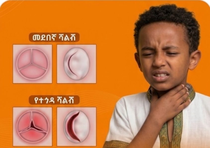 á¨á¶áá²á áá¶ á¥áá á¥á á¨áá¥ áªá (Rheumatic Heart Disease) áááááµ